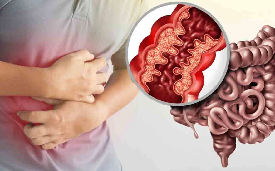 Crohn's disease symptoms in women