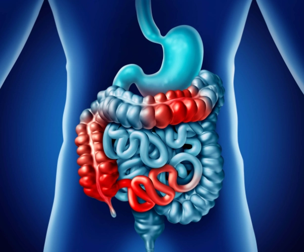 women with Crohn's disease