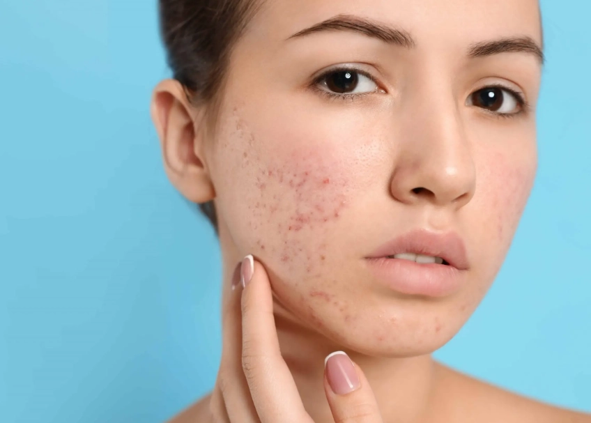adult female acne treatment