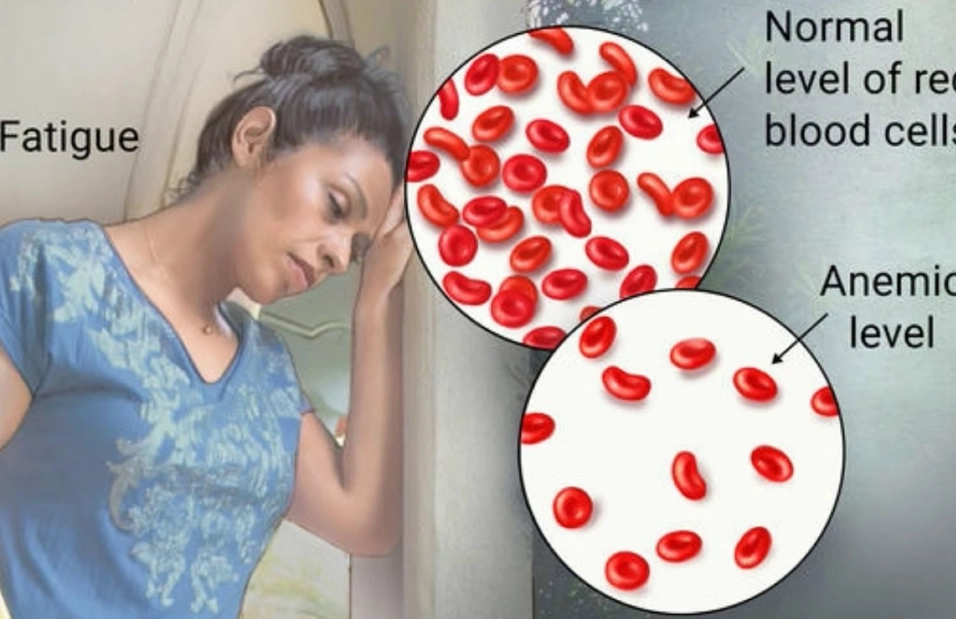 iron deficiency anemia treatment