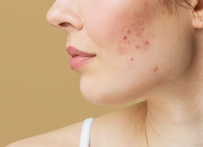 best acne products for women