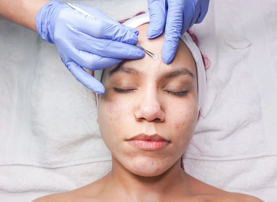 how to get rid of acne