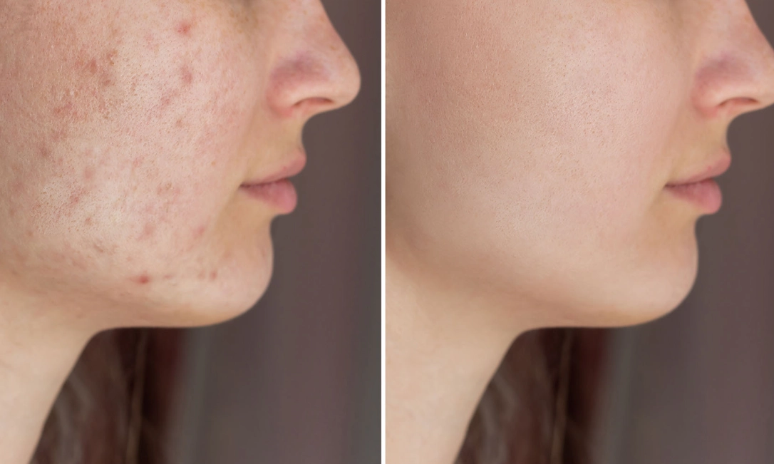 acne treatment