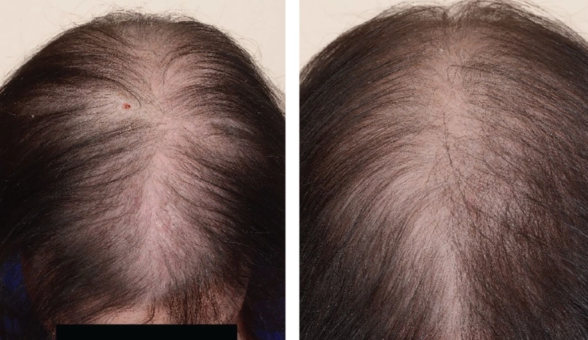 thinning hair women