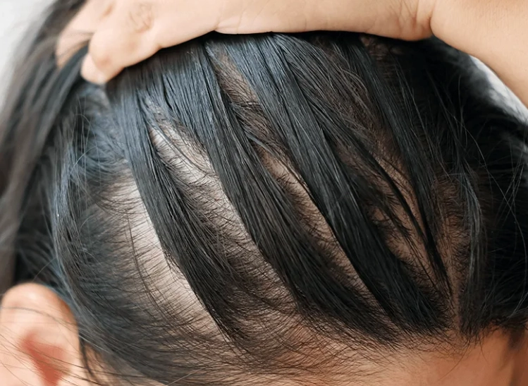 androgenetic alopecia in women
