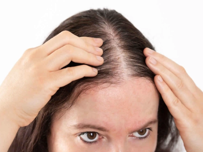 female hair loss