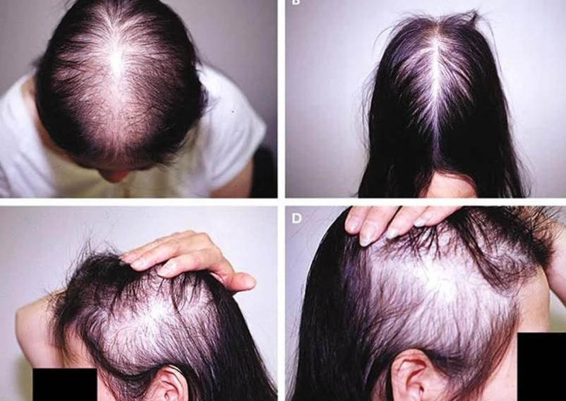 women's hair loss treatment