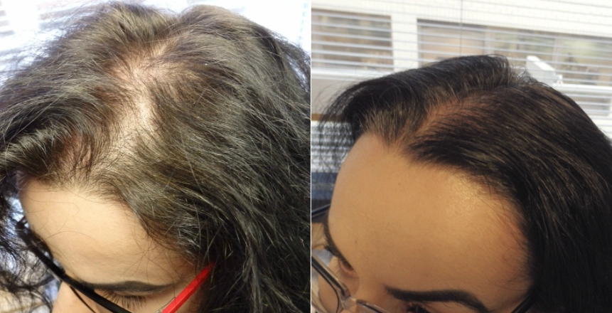 women hair loss treatment