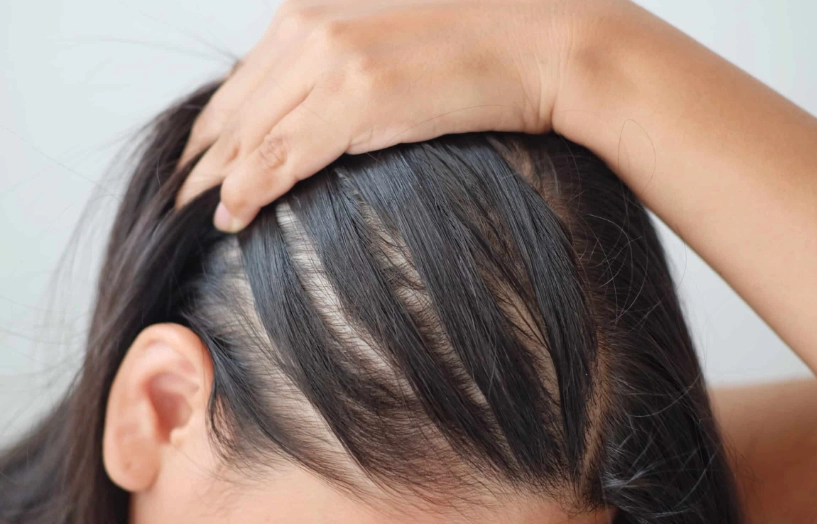 women hair loss treatment