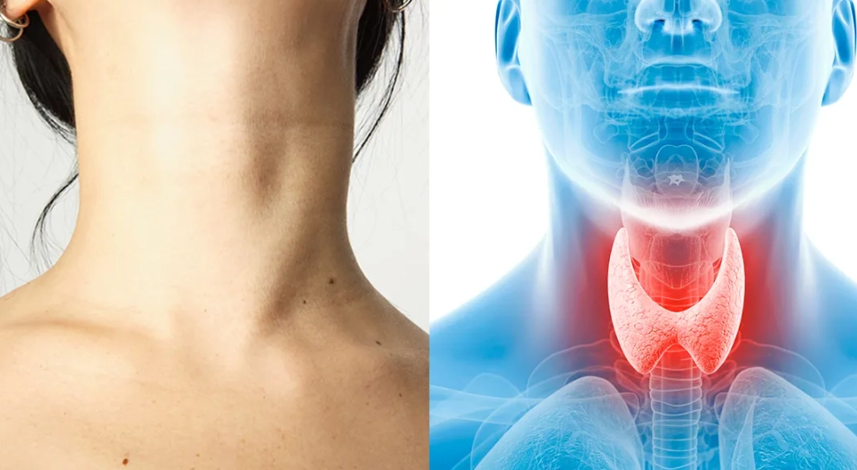 women's thyroid health