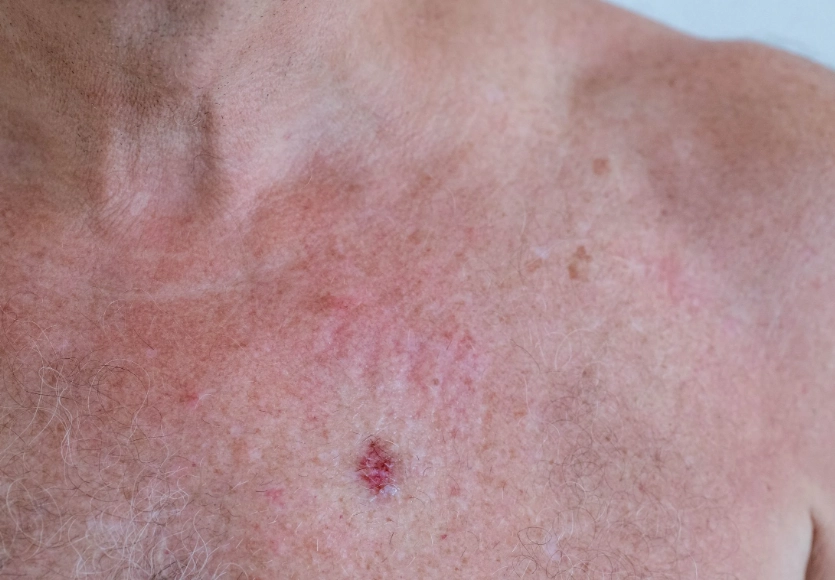melanoma in women