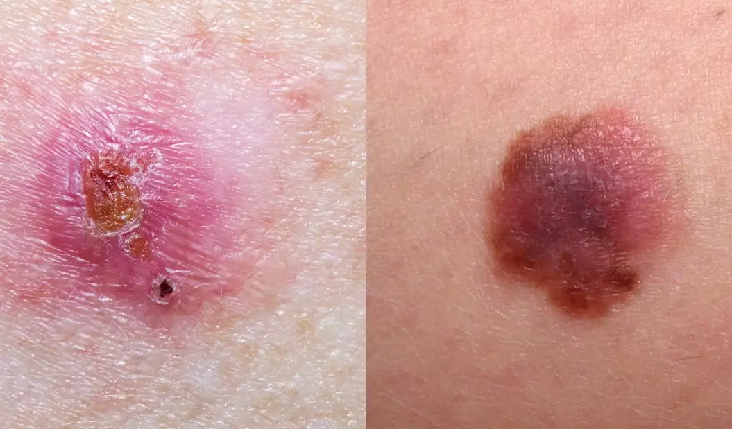 signs of skin cancer