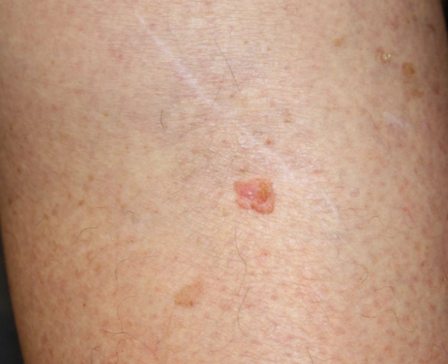 melanoma in women