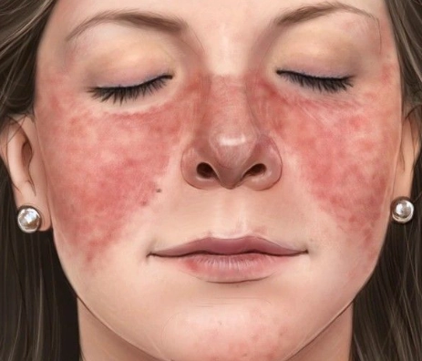 lupus symptoms women