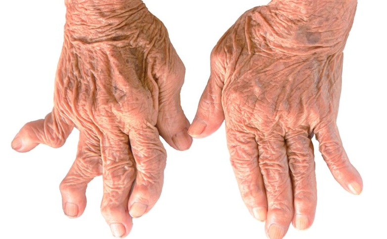 arthritis symptoms in women