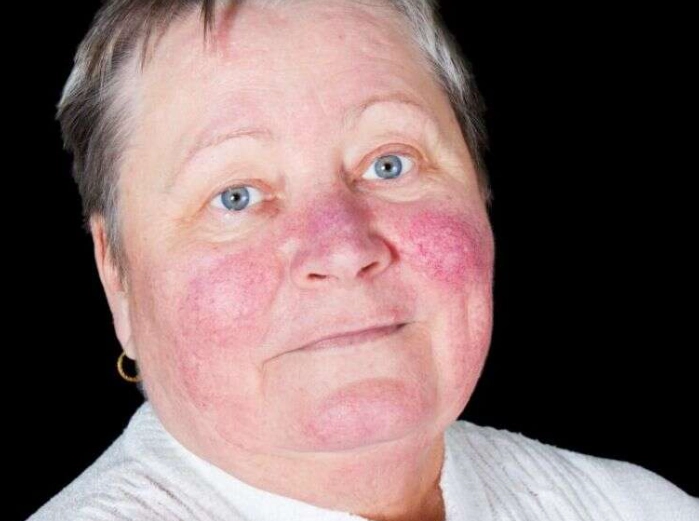 living with lupus women