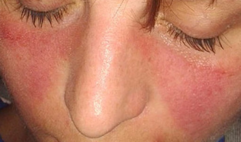 living with lupus women