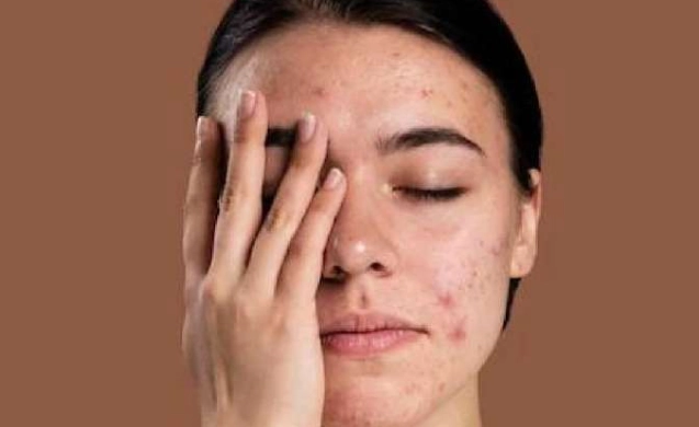 lupus diagnosis women