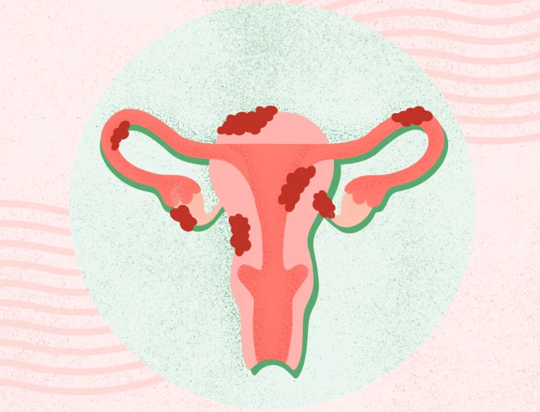 endometriosis causes endometriosis causes