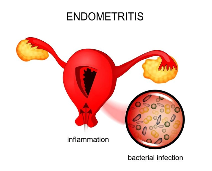 endometriosis causes endometriosis causes