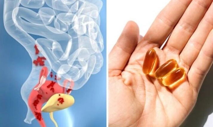 endometriosis and fertility endometriosis and fertility