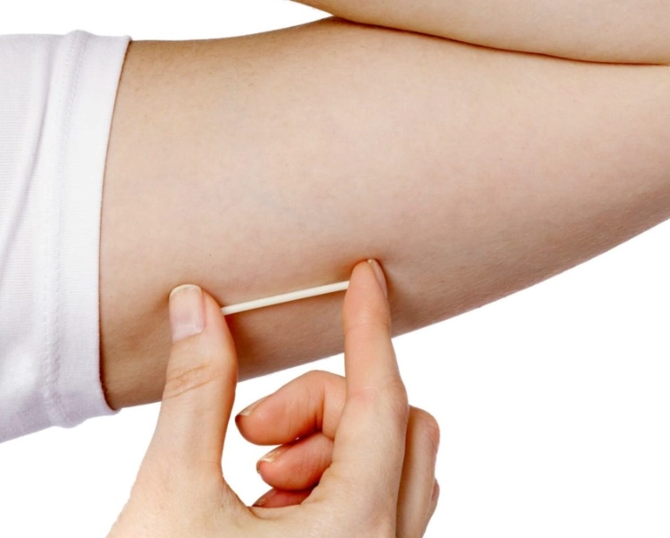 birth control implant
