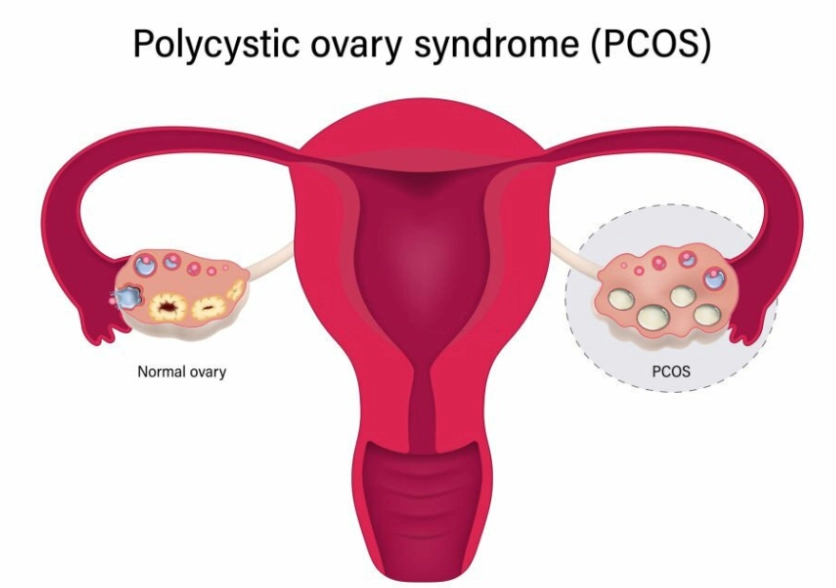 PCOS symptoms checklist PCOS symptoms checklist