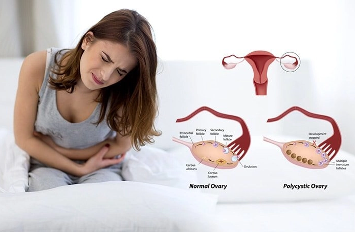 early signs of ovarian cancer early signs of ovarian cancer