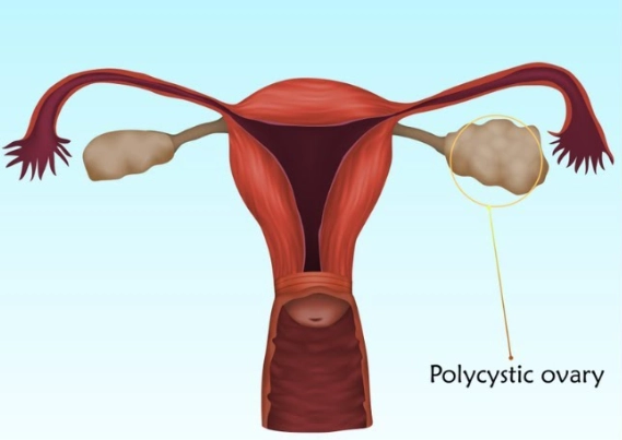 PCOS diet plan PCOS diet plan