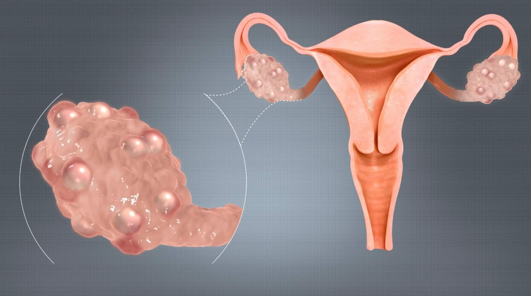 ovarian cyst symptoms ovarian cyst symptoms