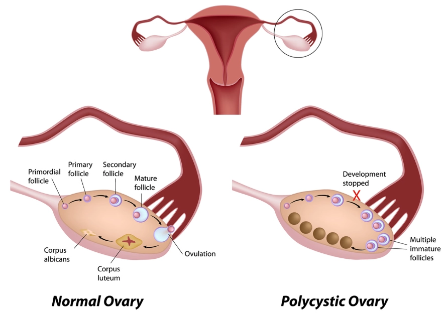 premature ovarian failure premature ovarian failure