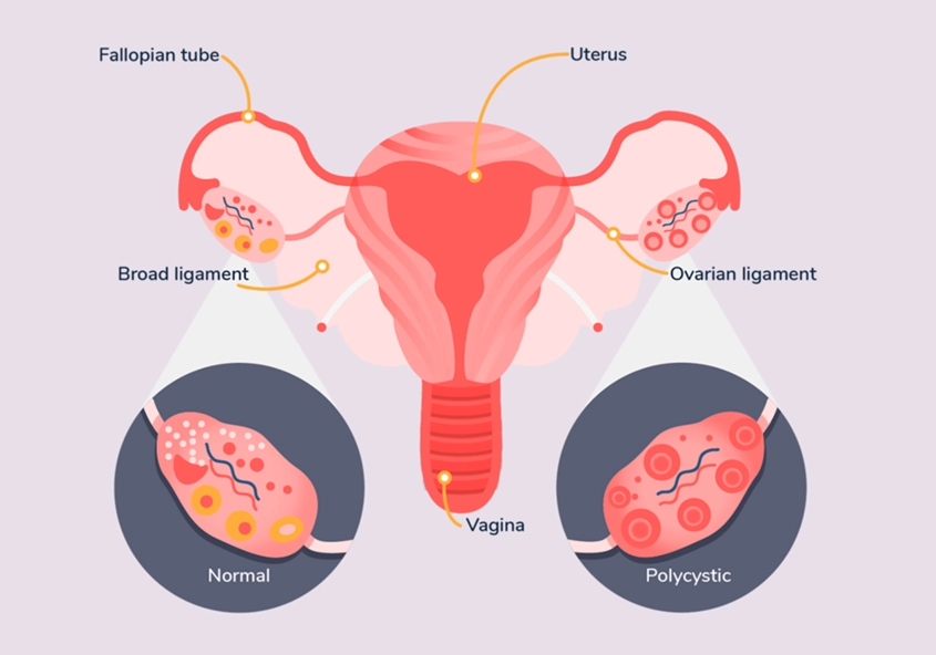 ovarian cyst symptoms ovarian cyst symptoms