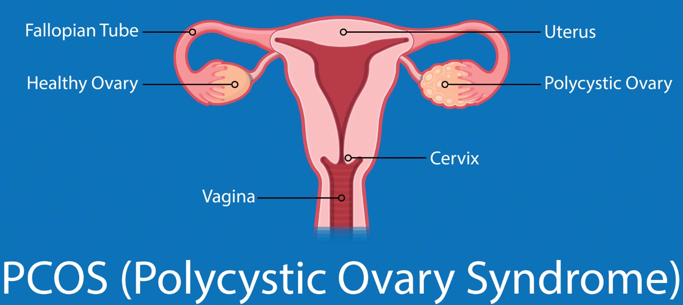 abdominal bloating women