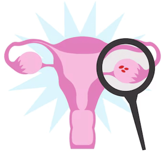 ovarian cancer symptoms