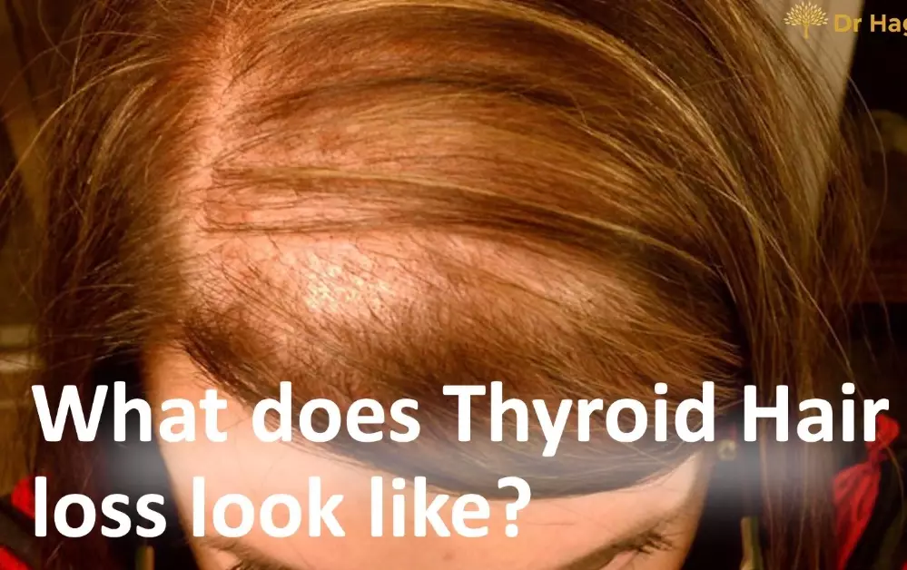 Thyroid issues in women hair loss
