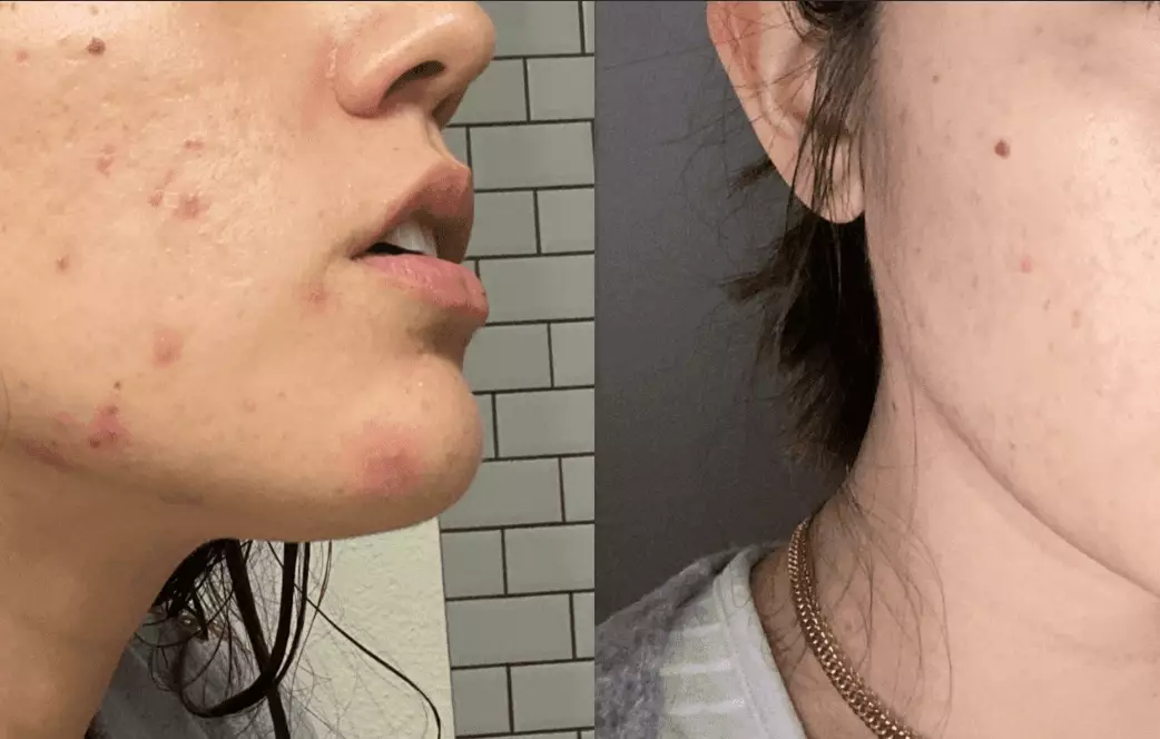 pregnancy acne