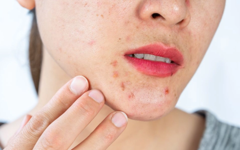 how to clear acne