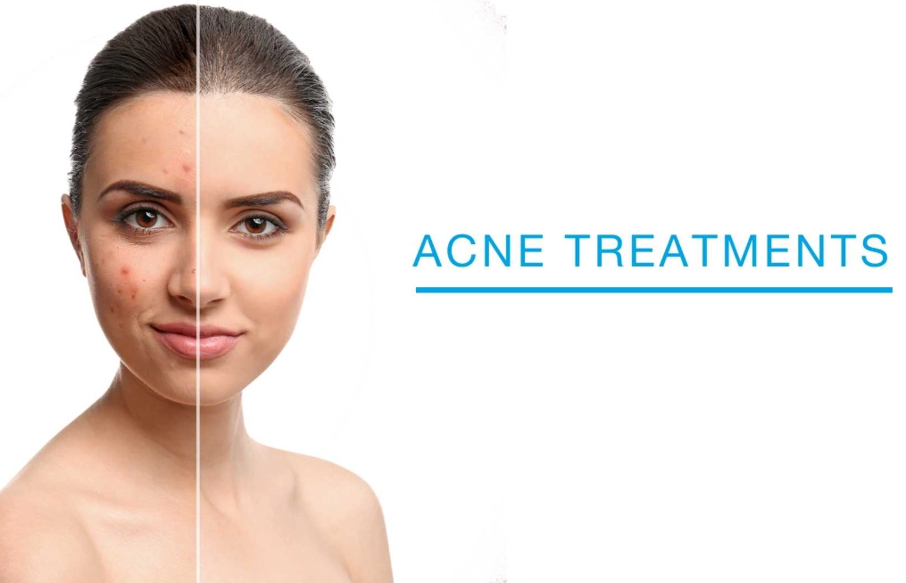 how to clear acne how to clear acne