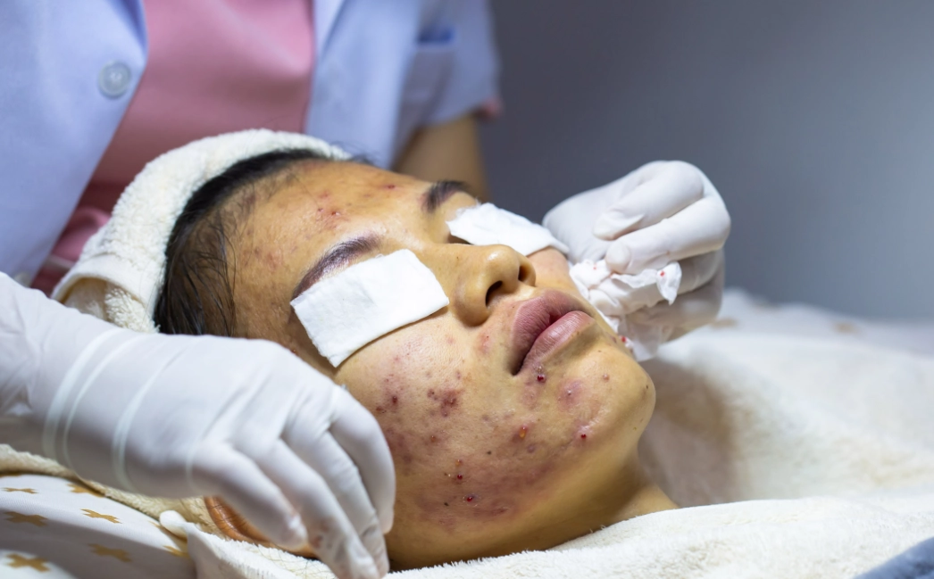 acne treatment acne treatment