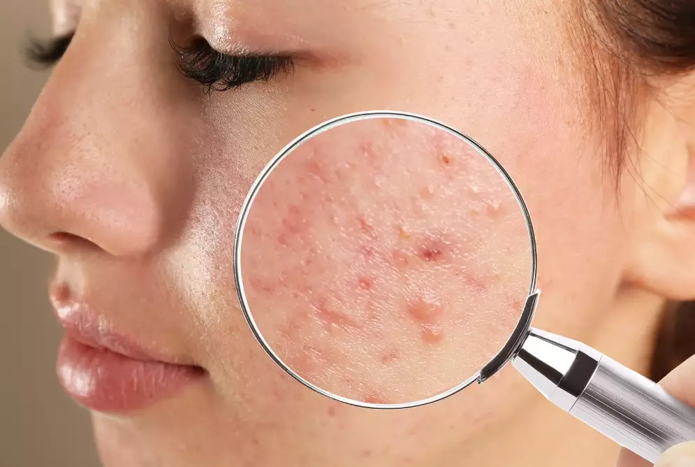 How do I clear my face of acne?