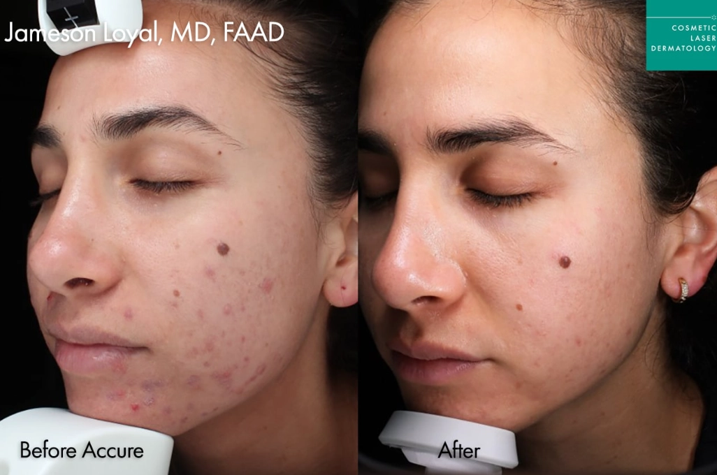Treatment for acne